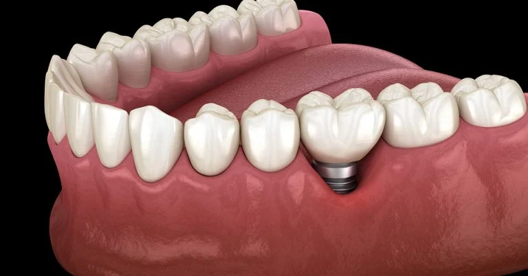 How Much Does a Dental Implant Cost in Winterville, NC?